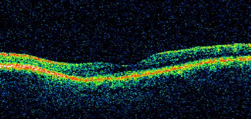 Chronic Central Serous Retinopathy - Gutter in Both Eyes - Treated with PDT - Visudyne
69-year-old man with blurred vision in the right eye for about three weeks.  He had a similar episode about twenty years ago which lasted about six weeks.  He is not taking any steroids.  He takes Lupron injections for his prostate cancer every three months. 

VISUAL ACUITY:  Vision OD is 20/80
FU: Treated with PDT after 6 months of observation with success.  Treatment was done to area between nerve and fovea at 1/2 fluence.
Keywords: csr;visudyne;chronic;gutter;serous