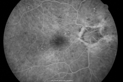 Diabetic Macular Edema with Circinate Exudate 
74-year-old man has diabetic macular edema in both eyes and background diabetic retinopathy.  His vision has blurred over the last few months.  His blood sugars have been fluctuating.

VISUAL ACUITY: Vision OD is 20/25, OS is 20/80
