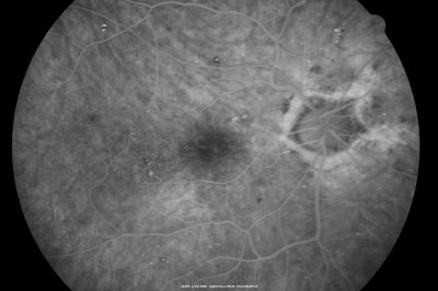 Diabetic Macular Edema with Circinate Exudate 
74-year-old man has diabetic macular edema in both eyes and background diabetic retinopathy.  His vision has blurred over the last few months.  His blood sugars have been fluctuating.

VISUAL ACUITY: Vision OD is 20/25, OS is 20/80
