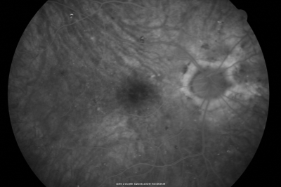 Diabetic Macular Edema with Circinate Exudate 
74-year-old man has diabetic macular edema in both eyes and background diabetic retinopathy.  His vision has blurred over the last few months.  His blood sugars have been fluctuating.

VISUAL ACUITY: Vision OD is 20/25, OS is 20/80
