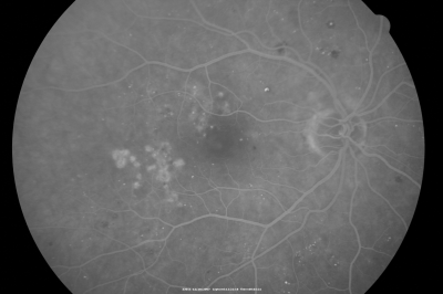 Focal Laser for diabetic macular edema
66 year old female with diabetes for 45 years.  VA 20/20 OU.  Extrafoveal edema in the left eye treated with light focal laser.
