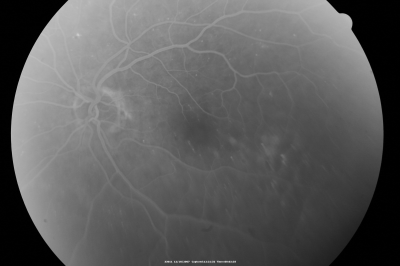 Focal Laser for diabetic macular edema
66 year old female with diabetes for 45 years.  VA 20/20 OU.  Extrafoveal edema in the left eye treated with light focal laser.
