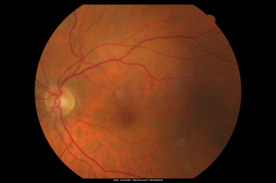 Focal Laser for diabetic macular edema
66 year old female with diabetes for 45 years.  VA 20/20 OU.  Extrafoveal edema in the left eye treated with light focal laser.
