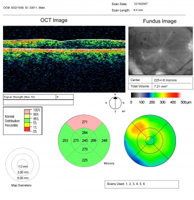 Focal Laser for diabetic macular edema
66 year old female with diabetes for 45 years.  VA 20/20 OU.  Extrafoveal edema in the left eye treated with light focal laser.
