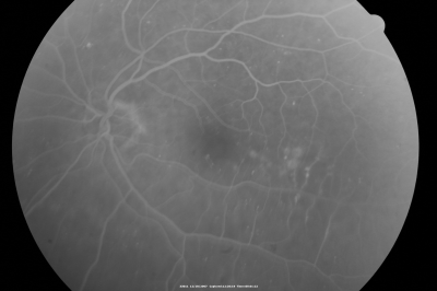 Focal Laser for diabetic macular edema
66 year old female with diabetes for 45 years.  VA 20/20 OU.  Extrafoveal edema in the left eye treated with light focal laser.
