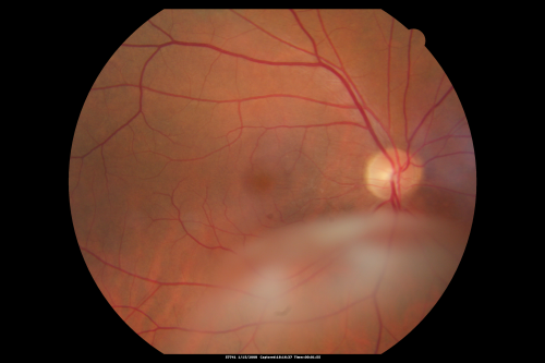 Big Floater - From Spontaneously Peeled Vitreomacular Traction Macular Pucker
54-year-old woman has had a visually significant and debilitating vitreous opacity in the right eye, which has been there for 2 years.  It is, if anything, getting worse.  When she moves her eye around it lands right in her central vision most of the time.

VISUAL ACUITY:  Her vision OD is 20/20
Keywords: floater;opacity;vitreomacular traction;macular pucker