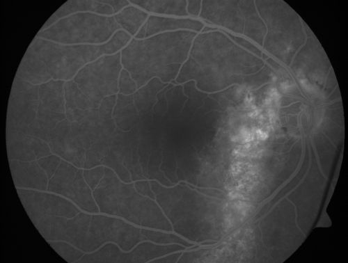 Chronic Central Serous Retinopathy - Gutter in Both Eyes - Treated with PDT - Visudyne
69-year-old man with blurred vision in the right eye for about three weeks.  He had a similar episode about twenty years ago which lasted about six weeks.  He is not taking any steroids.  He takes Lupron injections for his prostate cancer every three months. 

VISUAL ACUITY:  Vision OD is 20/80
FU: Treated with PDT after 6 months of observation with success.  Treatment was done to area between nerve and fovea at 1/2 fluence.
Keywords: csr;visudyne;chronic;gutter;serous