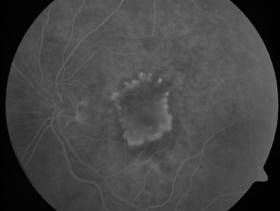 Subfoveal CNVM wet AMD early fa full image
She has noticed decreased vision in the left eye.  It is hard to say for how long, maybe a few months.  She had her last eye exam about a year ago.  She thoughts perhaps it was cataracts, but you saw a problem with the macula and suggested she come here for evaluation.

VISUAL ACUITY: Vision OD is 20/25, OS is 2/200
Keywords: wet amd; macular degeneration; classic; subfoveal cnvm;