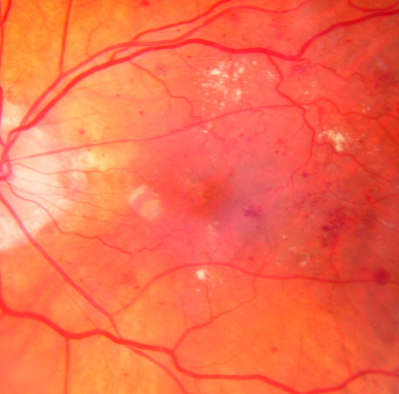 Diabetic Macular Edema with Circinate Exudate macular photo
74-year-old man has diabetic macular edema in both eyes and background diabetic retinopathy.  His vision has blurred over the last few months.  His blood sugars have been fluctuating.

VISUAL ACUITY: Vision OD is 20/25, OS is 20/80
