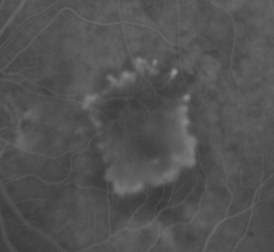 Subfoveal CNVM wet AMD early fa
She has noticed decreased vision in the left eye.  It is hard to say for how long, maybe a few months.  She had her last eye exam about a year ago.  She thoughts perhaps it was cataracts, but you saw a problem with the macula and suggested she come here for evaluation.

VISUAL ACUITY: Vision OD is 20/25, OS is 2/200
Keywords: wet amd; macular degeneration; classic; subfoveal cnvm;