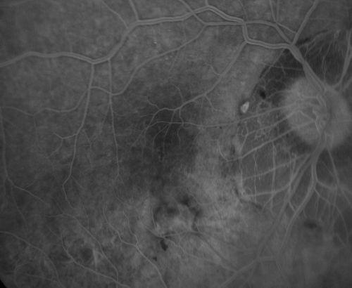 Myopic CNVM - Wet - rx Avastin for 1 year
55-year-old woman  OD is 20/40, OS is 20/20.  There is a hyperpigmented disc diameter choroidal neovascular membrane with fluid touching the fovea. 
Keywords: myopic;wet;macular degeneration;cnvm;avastin