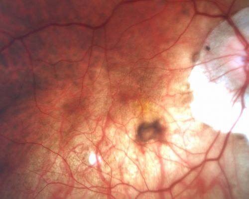 Myopic CNVM - Wet - rx Avastin for 1 year
55-year-old woman  OD is 20/40, OS is 20/20.  There is a hyperpigmented disc diameter choroidal neovascular membrane with fluid touching the fovea.
Mots-clés: myopic;wet;macular degeneration;cnvm;avastin