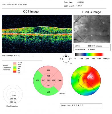 Diabetic Macular Edema with Circinate Exudate OCT Map
74-year-old man has diabetic macular edema in both eyes and background diabetic retinopathy.  His vision has blurred over the last few months.  His blood sugars have been fluctuating.

VISUAL ACUITY: Vision OD is 20/25, OS is 20/80
