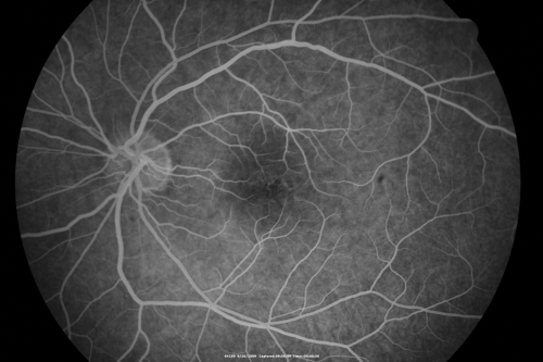 Multiple Evanescent White Dot Syndrome - Atypical Yellow Foveal Spot Right Eye
12-year-old had decreased vision in the left eye from reported amblyopia since around the year 2000.  His right eye was doing fine until  two days ago, when he had sudden severe vision loss.  He sees a blurred spot in the middle of the vision in the right eye wherever he looks. 
 OD 20/60 with eccentric movement, OS 20/200.   Pinhole 20/70.  IOP:  OD 14, OS 10.
Keywords: mewds;multiple evanescent white dot syndrome;yellow spot