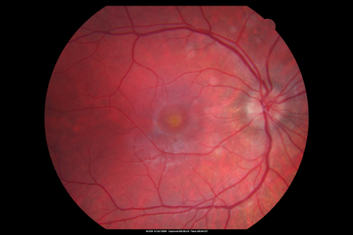 Multiple Evanescent White Dot Syndrome - Atypical Yellow Foveal Spot Right Eye
12-year-old had decreased vision in the left eye from reported amblyopia since around the year 2000.  His right eye was doing fine until  two days ago, when he had sudden severe vision loss.  He sees a blurred spot in the middle of the vision in the right eye wherever he looks. 
 OD 20/60 with eccentric movement, OS 20/200.   Pinhole 20/70.  IOP:  OD 14, OS 10.
Keywords: mewds;multiple evanescent white dot syndrome;yellow spot