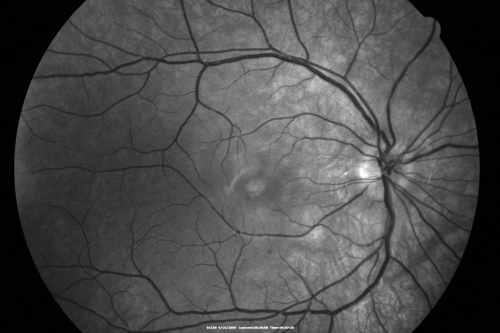 Multiple Evanescent White Dot Syndrome - Atypical Yellow Foveal Spot Right Eye
12-year-old had decreased vision in the left eye from reported amblyopia since around the year 2000.  His right eye was doing fine until  two days ago, when he had sudden severe vision loss.  He sees a blurred spot in the middle of the vision in the right eye wherever he looks. 
 OD 20/60 with eccentric movement, OS 20/200.   Pinhole 20/70.  IOP:  OD 14, OS 10.
Keywords: mewds;multiple evanescent white dot syndrome;yellow spot