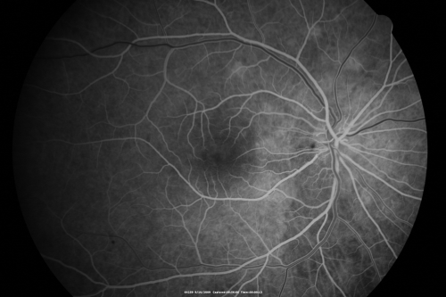 Multiple Evanescent White Dot Syndrome - Atypical Yellow Foveal Spot Right Eye
12-year-old had decreased vision in the left eye from reported amblyopia since around the year 2000.  His right eye was doing fine until  two days ago, when he had sudden severe vision loss.  He sees a blurred spot in the middle of the vision in the right eye wherever he looks. 
 OD 20/60 with eccentric movement, OS 20/200.   Pinhole 20/70.  IOP:  OD 14, OS 10.
Keywords: mewds;multiple evanescent white dot syndrome;yellow spot