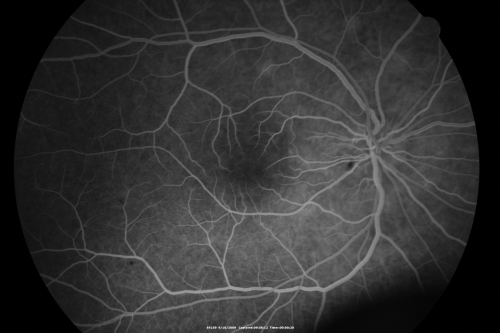 Multiple Evanescent White Dot Syndrome - Atypical Yellow Foveal Spot Right Eye
12-year-old had decreased vision in the left eye from reported amblyopia since around the year 2000.  His right eye was doing fine until  two days ago, when he had sudden severe vision loss.  He sees a blurred spot in the middle of the vision in the right eye wherever he looks. 
 OD 20/60 with eccentric movement, OS 20/200.   Pinhole 20/70.  IOP:  OD 14, OS 10.
Keywords: mewds;multiple evanescent white dot syndrome;yellow spot