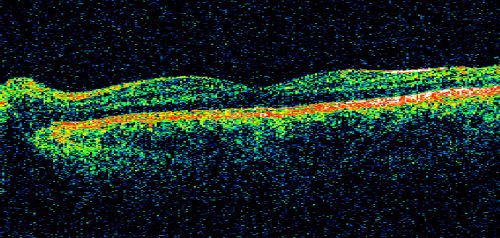 Multiple Evanescent White Dot Syndrome - Atypical Yellow Foveal Spot Right Eye
12-year-old had decreased vision in the left eye from reported amblyopia since around the year 2000.  His right eye was doing fine until  two days ago, when he had sudden severe vision loss.  He sees a blurred spot in the middle of the vision in the right eye wherever he looks. 
 OD 20/60 with eccentric movement, OS 20/200.   Pinhole 20/70.  IOP:  OD 14, OS 10.
Schlüsselwörter: mewds;multiple evanescent white dot syndrome;yellow spot