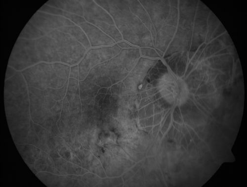 Myopic CNVM - Wet - rx Avastin for 1 year
55-year-old woman  OD is 20/40, OS is 20/20.  There is a hyperpigmented disc diameter choroidal neovascular membrane with fluid touching the fovea. 
Keywords: myopic;wet;macular degeneration;cnvm;avastin