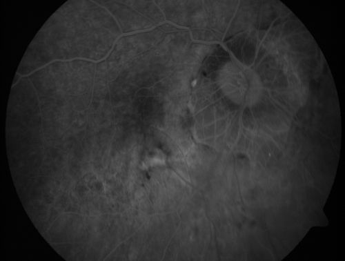 Myopic CNVM - Wet - rx Avastin for 1 year
55-year-old woman  OD is 20/40, OS is 20/20.  There is a hyperpigmented disc diameter choroidal neovascular membrane with fluid touching the fovea.
Keywords: myopic;wet;macular degeneration;cnvm;avastin