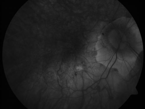 Myopic CNVM - Wet - rx Avastin for 1 year
55-year-old woman  OD is 20/40, OS is 20/20.  There is a hyperpigmented disc diameter choroidal neovascular membrane with fluid touching the fovea.
Keywords: myopic;wet;macular degeneration;cnvm;avastin
