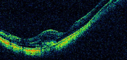 Myopic CNVM - Wet - rx Avastin for 1 year
55-year-old woman  OD is 20/40, OS is 20/20.  There is a hyperpigmented disc diameter choroidal neovascular membrane with fluid touching the fovea.
Keywords: myopic;wet;macular degeneration;cnvm;avastin