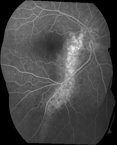 Chronic Central Serous Retinopathy - Gutter in Both Eyes - Treated with PDT - Visudyne
69-year-old man with blurred vision in the right eye for about three weeks.  He had a similar episode about twenty years ago which lasted about six weeks.  He is not taking any steroids.  He takes Lupron injections for his prostate cancer every three months. 

VISUAL ACUITY:  Vision OD is 20/80
FU: Treated with PDT after 6 months of observation with success.  Treatment was done to area between nerve and fovea at 1/2 fluence.
Keywords: csr;visudyne;chronic;gutter;serous