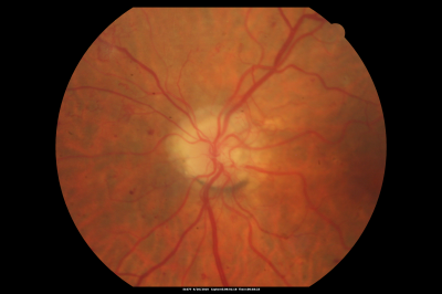 PDR OS with NVE
57-year-old man has diabetic retinopathy in both eyes. 
Diabetic for 14 years with HgB A1C often over 10. 
VISUAL ACUITY:  OD 20/30,  OS 20/40. PDR OS BDR OD
