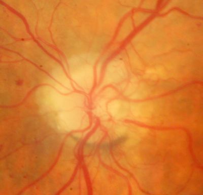PDR OS with NVE
57-year-old man has diabetic retinopathy in both eyes. 
Diabetic for 14 years with HgB A1C often over 10. 
VISUAL ACUITY:  OD 20/30,  OS 20/40. PDR OS BDR OD
