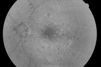PDR OS with NVE
57-year-old man has diabetic retinopathy in both eyes. 
Diabetic for 14 years with HgB A1C often over 10. 
VISUAL ACUITY:  OD 20/30,  OS 20/40. PDR OS BDR OD
