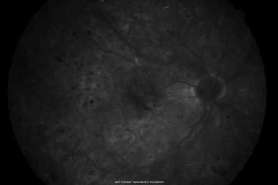 BDR OD with Edema
57-year-old man has diabetic retinopathy in both eyes. 
Diabetic for 14 years with HgB A1C often over 10. 
VISUAL ACUITY:  OD 20/30,  OS 20/40. PDR OS BDR OD
