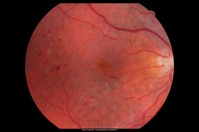BDR OD with Edema
57-year-old man has diabetic retinopathy in both eyes. 
Diabetic for 14 years with HgB A1C often over 10. 
VISUAL ACUITY:  OD 20/30,  OS 20/40. PDR OS BDR OD
