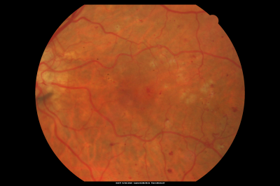 PDR OS with NVE
57-year-old man has diabetic retinopathy in both eyes. 
Diabetic for 14 years with HgB A1C often over 10. 
VISUAL ACUITY:  OD 20/30,  OS 20/40. PDR OS BDR OD
