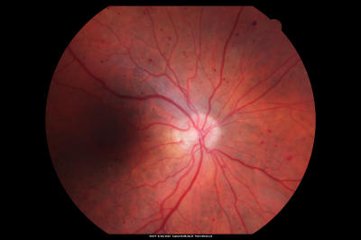 BDR OD with Edema
57-year-old man has diabetic retinopathy in both eyes. 
Diabetic for 14 years with HgB A1C often over 10. 
VISUAL ACUITY:  OD 20/30,  OS 20/40. PDR OS BDR OD
