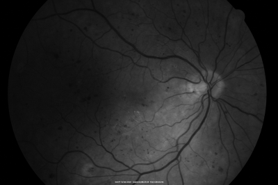 BDR OD with Edema
57-year-old man has diabetic retinopathy in both eyes. 
Diabetic for 14 years with HgB A1C often over 10. 
VISUAL ACUITY:  OD 20/30,  OS 20/40. PDR OS BDR OD
