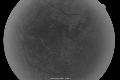 PDR OS with NVE
57-year-old man has diabetic retinopathy in both eyes. 
Diabetic for 14 years with HgB A1C often over 10. 
VISUAL ACUITY:  OD 20/30,  OS 20/40. PDR OS BDR OD
