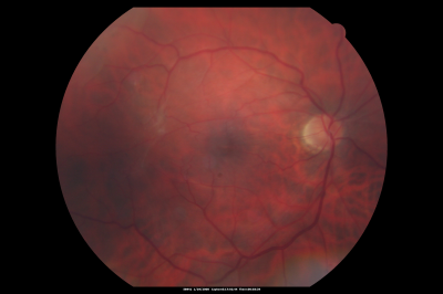 Macular Pucker in eye following giant retinal tear RD repair post-op Fundus Photo
now that the bubble is gone, but he is starting to notice distortion of central vision.  He had a giant retinal tear retinal detachment repair emergently done on November 8, 2007, and subsequent laser on November 15th.  
 
VISUAL ACUITY:  Vision OD 20/400.  

6 weeks post-op VA 20/40
Keywords: macular pucker; post-retinal detachment; giant retinal tear