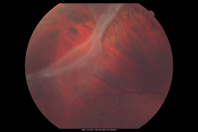 Macular Pucker in eye following giant retinal tear RD repair photo of tear
now that the bubble is gone, but he is starting to notice distortion of central vision.  He had a giant retinal tear retinal detachment repair emergently done on November 8, 2007, and subsequent laser on November 15th.  
 
VISUAL ACUITY:  Vision OD 20/400.  

6 weeks post-op VA 20/40
Keywords: macular pucker; post-retinal detachment; giant retinal tear