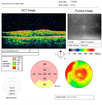 Macular Pucker in eye following giant retinal tear RD repair post-op OCT map
now that the bubble is gone, but he is starting to notice distortion of central vision.  He had a giant retinal tear retinal detachment repair emergently done on November 8, 2007, and subsequent laser on November 15th.  
 
VISUAL ACUITY:  Vision OD 20/400.  

6 weeks post-op VA 20/40
Keywords: macular pucker; post-retinal detachment; giant retinal tear