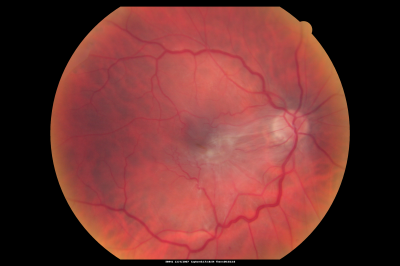 Macular Pucker in eye following giant retinal tear RD repair pre-op pucker photo
now that the bubble is gone, but he is starting to notice distortion of central vision.  He had a giant retinal tear retinal detachment repair emergently done on November 8, 2007, and subsequent laser on November 15th.  
 
VISUAL ACUITY:  Vision OD 20/400.  

6 weeks post-op VA 20/40
Keywords: macular pucker; post-retinal detachment; giant retinal tear