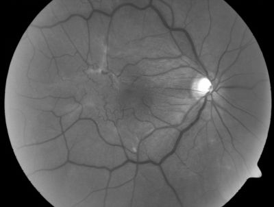 Macular Pucker
This pleasant 59-year-old man was seen in the office on 7/9/2010.  He had new onset floaters about a year ago.  Subsequent to that his vision was not quite right in the right eye and then he noticed, starting about three weeks ago, substantial change in the vision.   In the morning he sees what he calls a small gray circle with a ring of fire around it and then subsequent to that the vision becomes more normal but not quite right.  His vision in the left eye is fine.  Vision OD is 20/50, OS is 20/16.  
Keywords: Macular Pucker