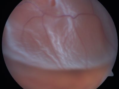 Retinal Detachment
Keywords: Retinal Detachment