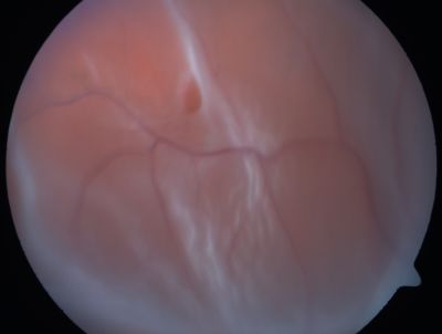 Retinal Detachment
Võtmesõnad: Retinal Detachment