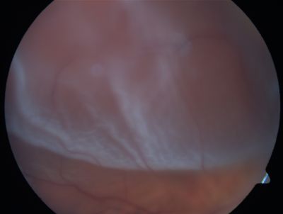 Retinal Detachment
Keywords: Retinal Detachment