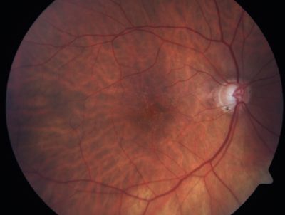 post retinal detachment repair
72-year-old with a history of retinal detachment in the right eye.  He had pneumatic retinopexy followed by panretinal laser.  He returns today reporting that he is seeing fairly well but the central vision in the right eye is not as clear as it used to be.

OPHTHALMIC EXAM:  Visual acuity with correction of 20/100 OD, 20/20 OS; PH 20/80 OD.  IOP: 18 OD.


Keywords: retinal detachment
