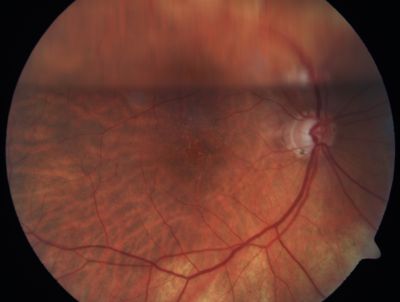 Retinal Detachment
Keywords: Retinal Detachment