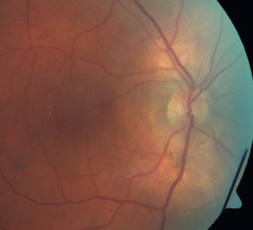 Peripapillary Lesion Hemangioma or CNVM Color Fundus Photo Abnormal Right Eye
67-year-old man with a history of a peripapillary lesion in the right eye.  
Keywords: peripapillary;hemangioma;unknown