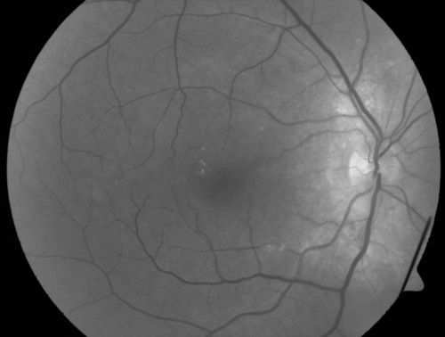 Peripapillary Lesion Hemangioma or CNVM Red Free photo of abnormal right eye
67-year-old man with a history of a peripapillary lesion in the right eye.  
Keywords: peripapillary;hemangioma;unknown
