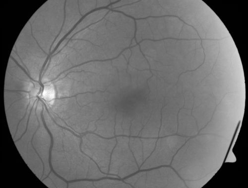 Peripapillary Lesion Hemangioma or CNVM Red Free photo of normal left eye
67-year-old man with a history of a peripapillary lesion in the right eye.  
Keywords: peripapillary;hemangioma;unknown